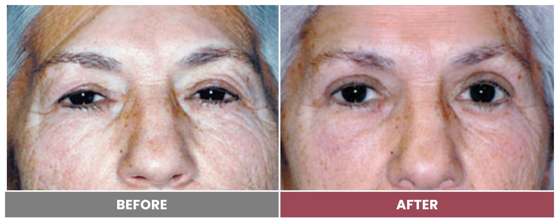 BLEPHAROPLASTY & PTOSIS REPAIR - Case 4